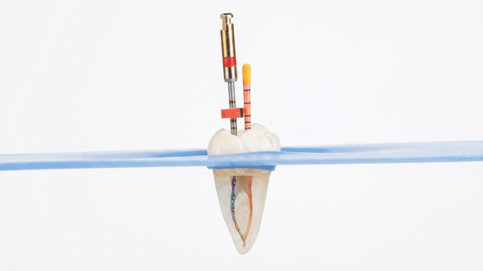 Root canal treatment Gulshan Dhaka