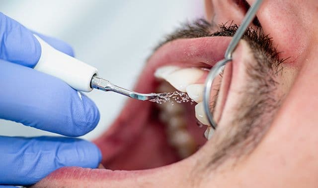Professional dental scaling and cleaning treatment