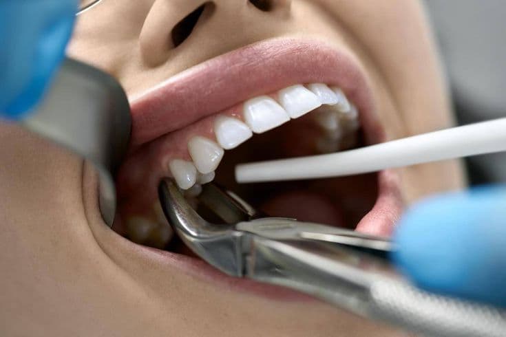 Safe tooth extraction procedure by dental specialist Dhaka